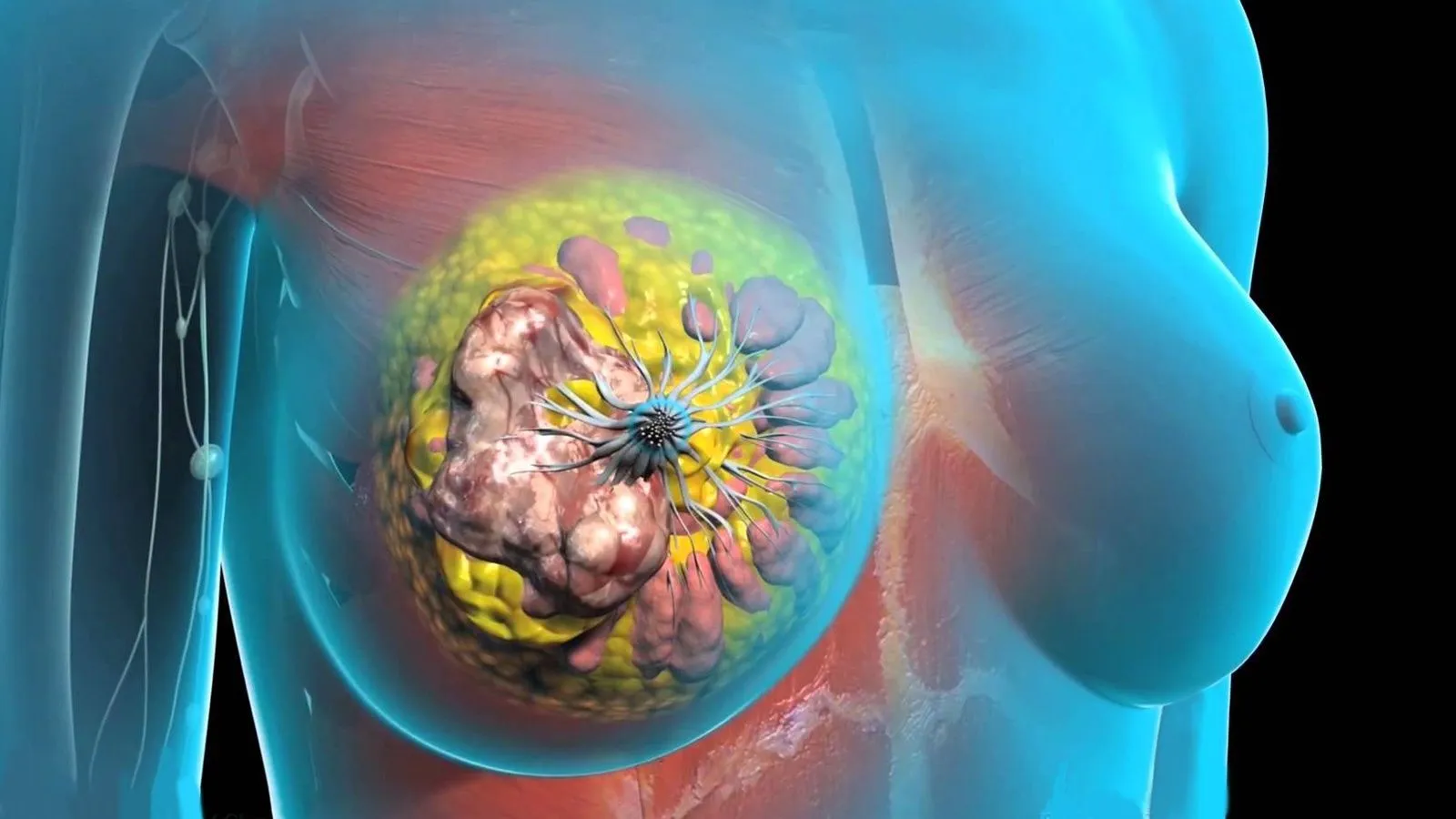 Голодание повышает эффективность терапии рака молочной железы за счет активации глюкокортикоидов