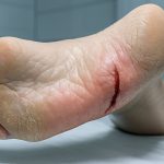 Осенью кожа на пятках трескается из-за сухости и нагрузки