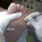 Стержневая мозоль и бородавка требуют разных дальнейших действий